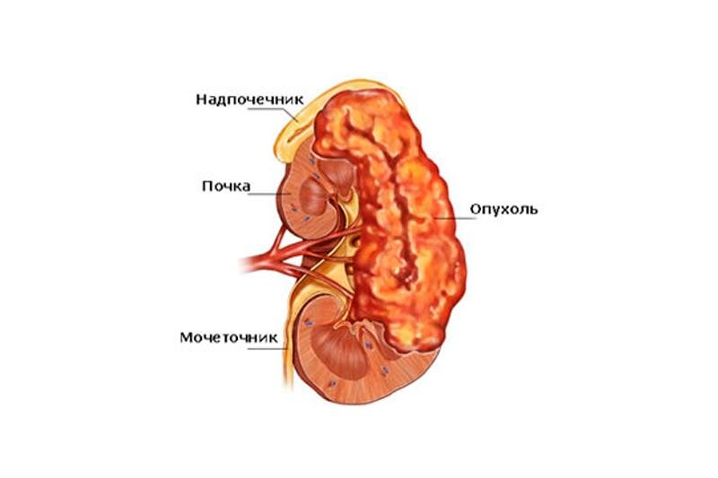 Надпочечник доброкачественный. Гормонально активные опухоли надпочечников. Гормонально неактивные опухоли надпочечников. Опухоль коркового слоя надпочечников. Почки и надпочечники.