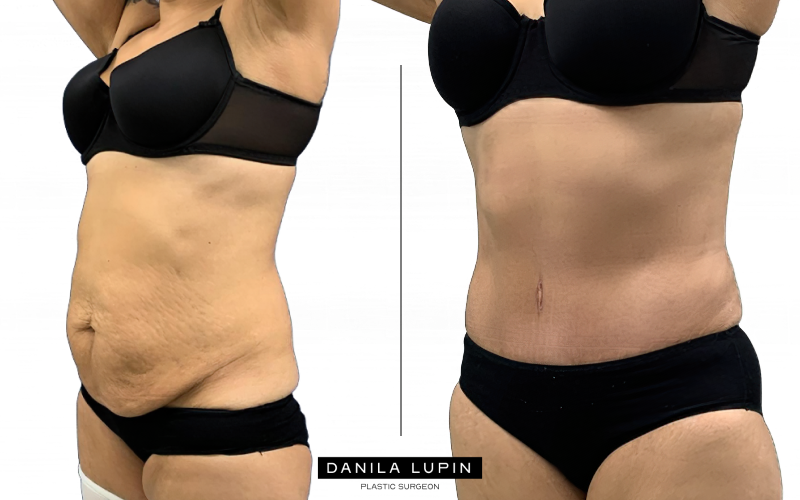 Абдоминопластика до и после. На фото пациентка Данилы Лупина. Имеются противопоказания, необходима консультация специалиста