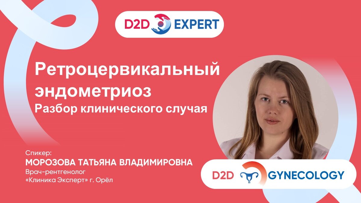 Клинический случай ретроцервикального эндометриоза | D2D Expert | Дзен