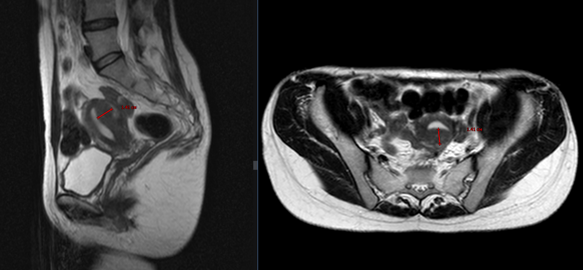 Рис.1: Т2 в сагиттальной (слева) и аксиальной (справа) плоскости. Утолщенный переходный слой до 1.4 см