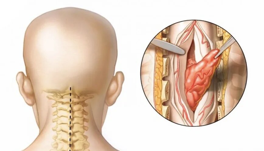  Опухоль позвоночника - это тип опухоли, поражающий кости или позвонки позвоночника.-5
