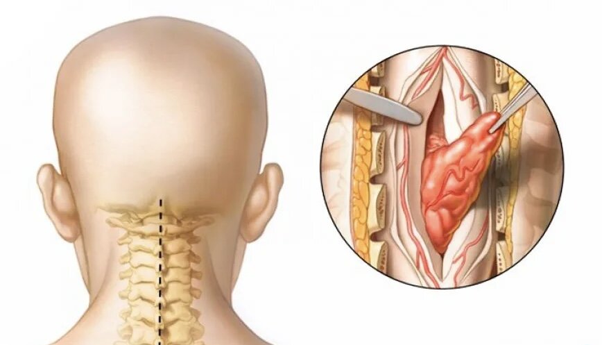 Опухоль позвоночника: причины, симптомы, варианты лечения