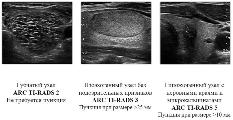 Щитовидная железа УЗИ ti-rads. Губчатый узел щитовидной железы на УЗИ. Кистозные образования в щитовидной железе по УЗИ. Коллоидное образование в щитовидной железе на УЗИ.