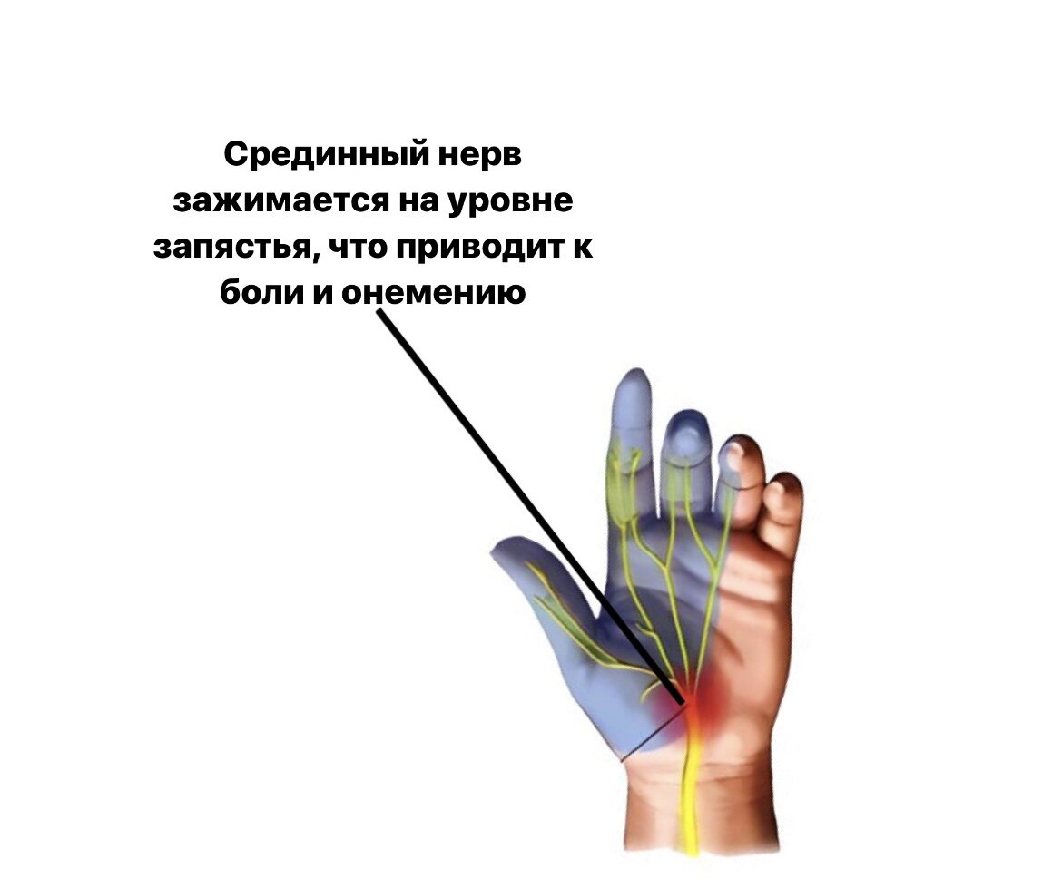 Почему немеют руки во сне ночью причины