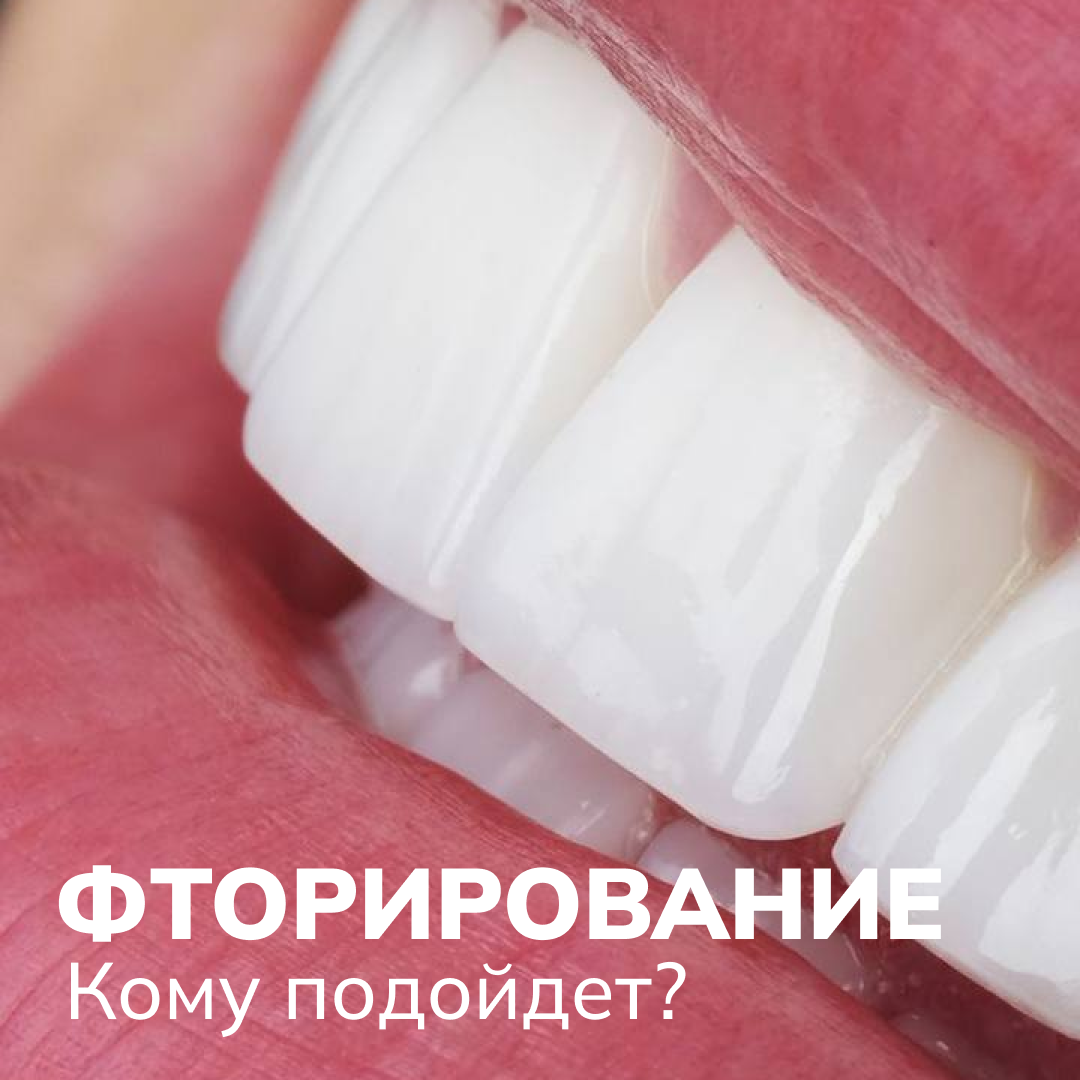 Что такое фторирование и кому подойдет? | Стоматология ЛИКС ДЕНТ | Дзен