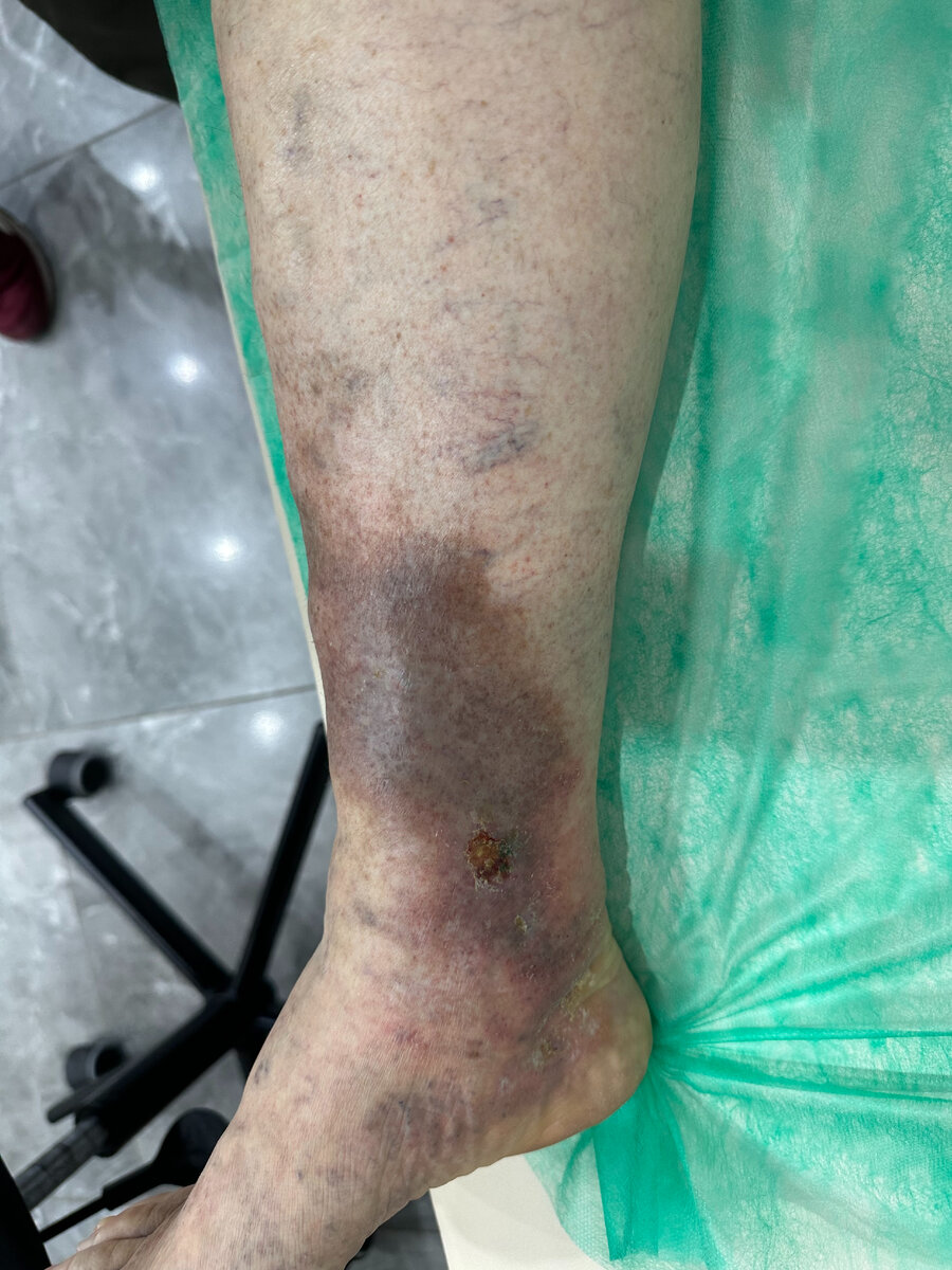 Пациент 65 лет, начинающаяся трофическая язва голени. Личное фото с приема пациентов