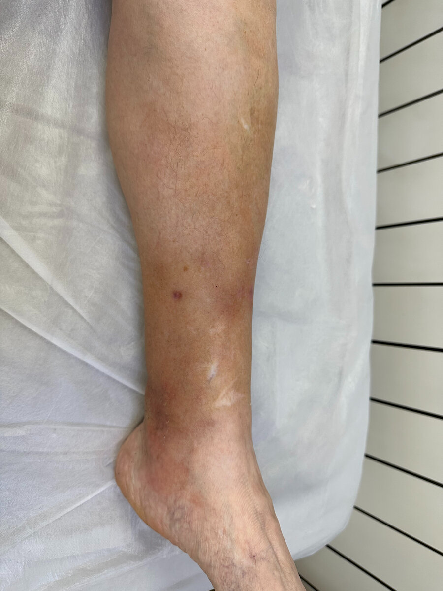 Потемнение кожных покровов на ногах при варикозе