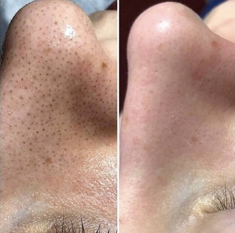 Угревая сыпь до и после борьбы с ней