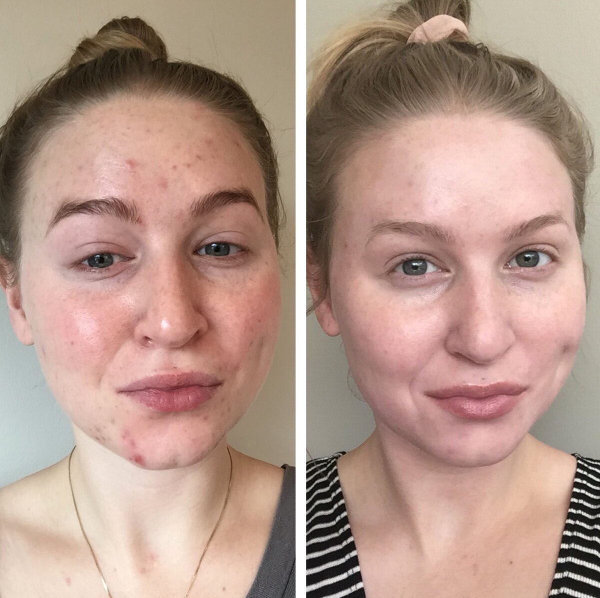 Угревая сыпь до и после соблюдения правил описанных ниже