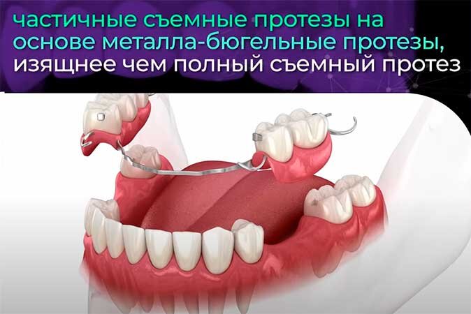 Частичные съемные протезы