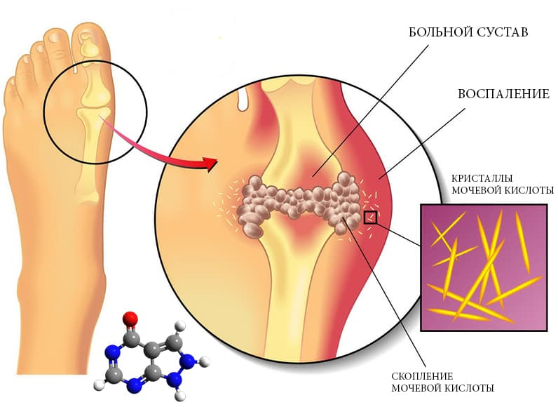 Соль в суставах лечение. Отложение кристаллов мочевой кислоты в суставах. Отложение солей мочевой кислоты в суставах.