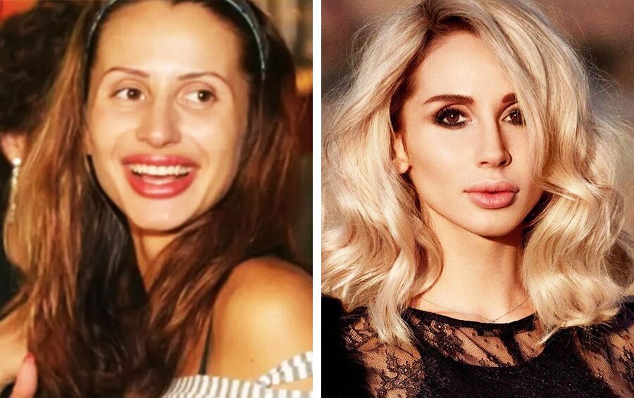 Иванова до и после пластики