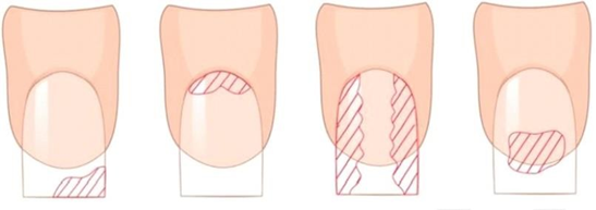Почему отслаивается гель от ногтей? 6 основных причин!