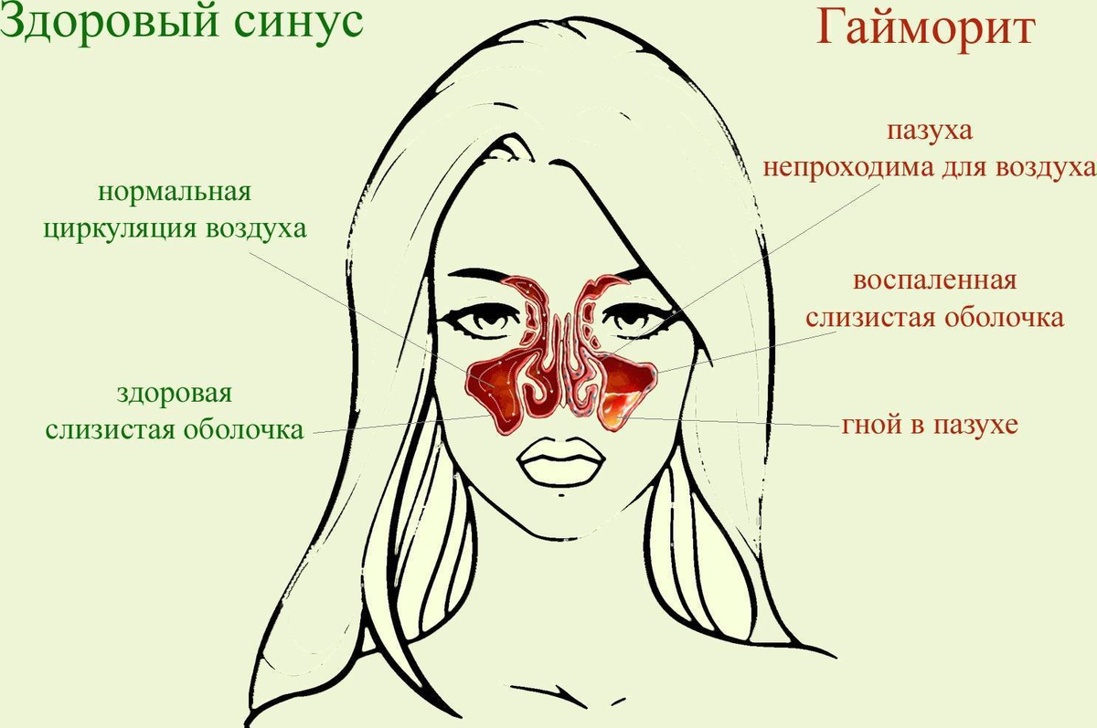 Синусит температура. Строение носа при насморке.