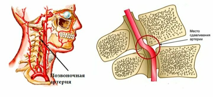 Компрессии шеи. Синдром сдавливания позвоночной артерии. Сдавление позвоночной артерии поясницы. Анатомия позвоночной артерии в шейном отделе. Сдавливание артерии в шейном отделе.