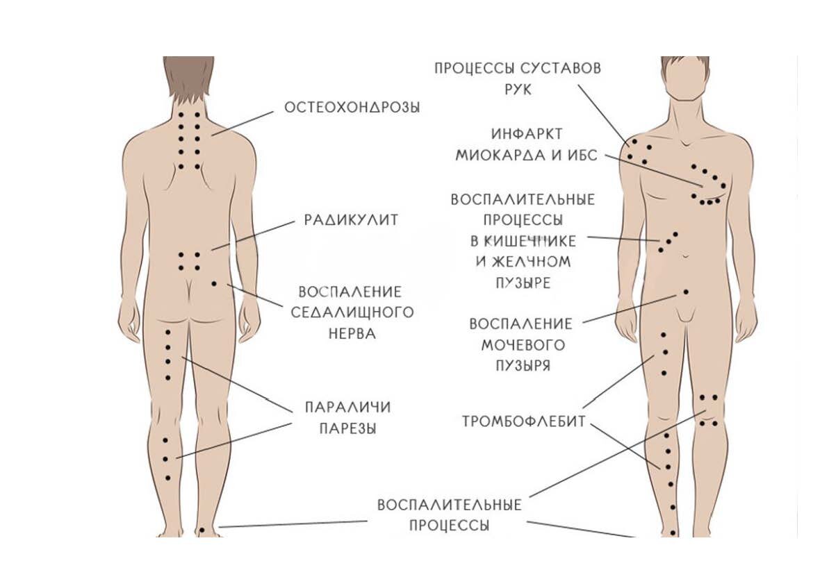 В каком месте можно ставить. Схема постановки пиявок на крестец. Точки постановки пиявок на ноги схема. Схема постановок пиявок при болезнях кишечника. Пиявки гирудотерапия схема лечения.