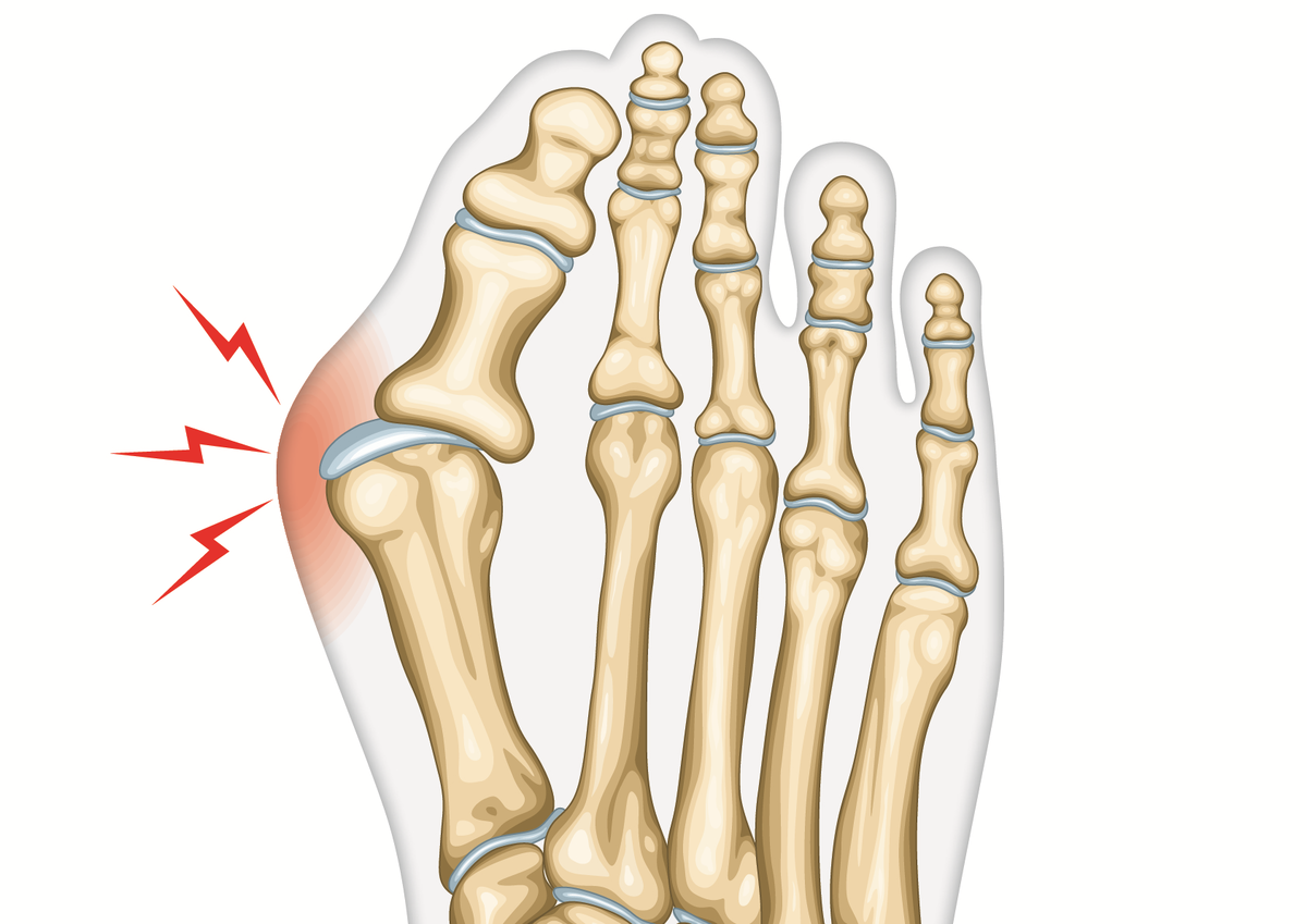 hallux valgus. Проблема большого пальца стопы. | Блог компании ORTO.NIK -  производитель оротопедических стелек Talus | Дзен