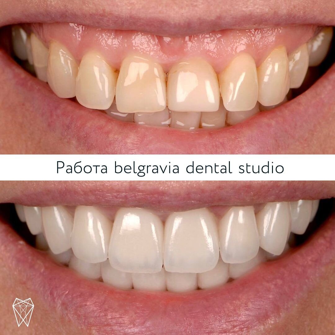 Случай из практики: прощай, десневая улыбка! | Стоматология Belgravia  Dental Studio | Дзен