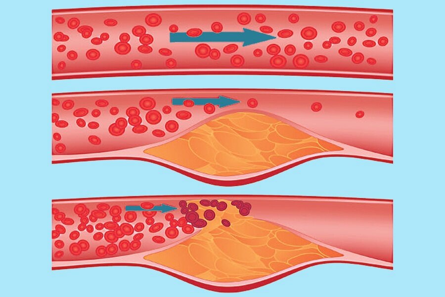 На верхнем изображении мы видим здоровый сосуд, по которому беспрепятственно движется кровь. На центральном рисунке просвет сосуда перекрыт атеросклеротической бляшкой, что замедлило кровоток в этой области. На нижнем рисунке произошел разрыв покрышки бляшки с формированием на ее поверхности тромба. Если такое происходит в артерии сердца, то развивается инфаркт миокарда.