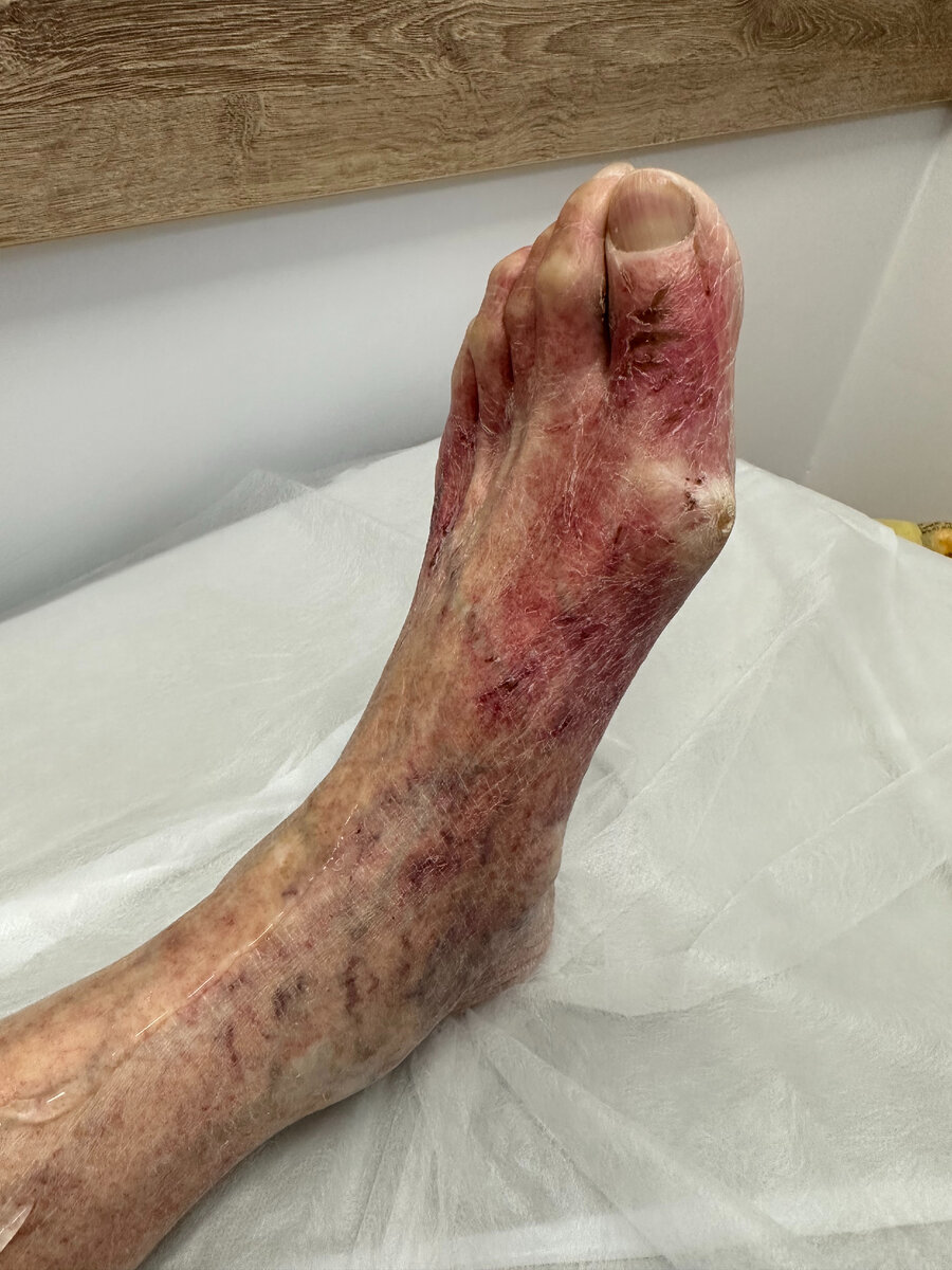 Пациент 55 лет, сахарный диабет 2 типа, стаж диабета 19 лет, максимальный уровень глюкозы до 22 ммоль/л. Облитерация подколенной артерий, а также артерий голени и стопы. Начинающаяся гангрена. Фото с приема 