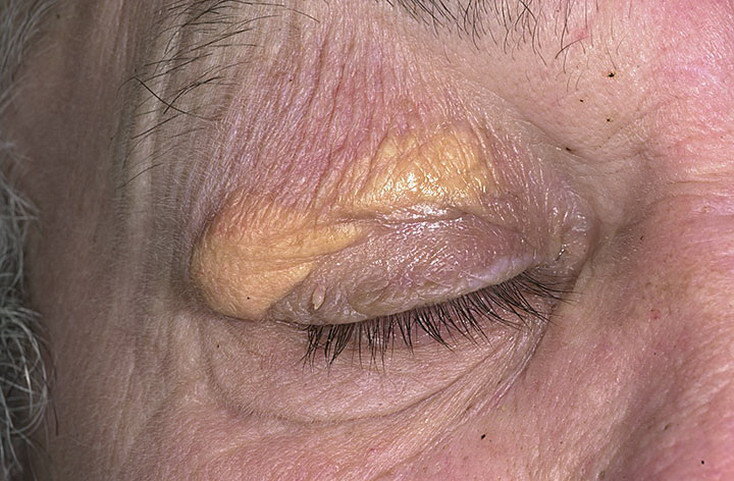 Ксантома верхнего века. Фото - yandex.ru