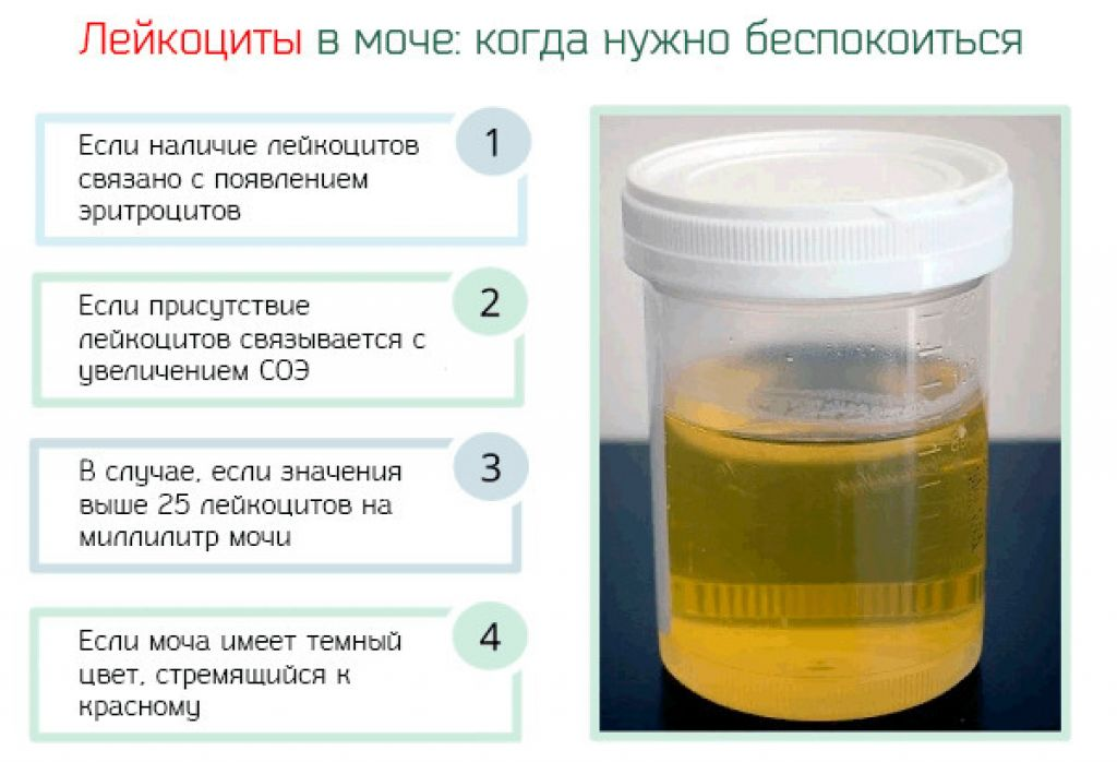 Лейкоциты в моче повышены у мужчины лечение. Лейкоциты в моче. Лейкоциты в моче повышены. Повыгкер лейкоциты в моче. Лейкоциты повышены в моче причины.