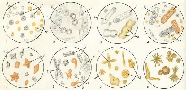 Соединительная ткань кал. Осадок мочи микроскопия. Эритроциты в моче микроскопия осадка. Копрология кала микроскопия. Микроскопия кала копрограмма.