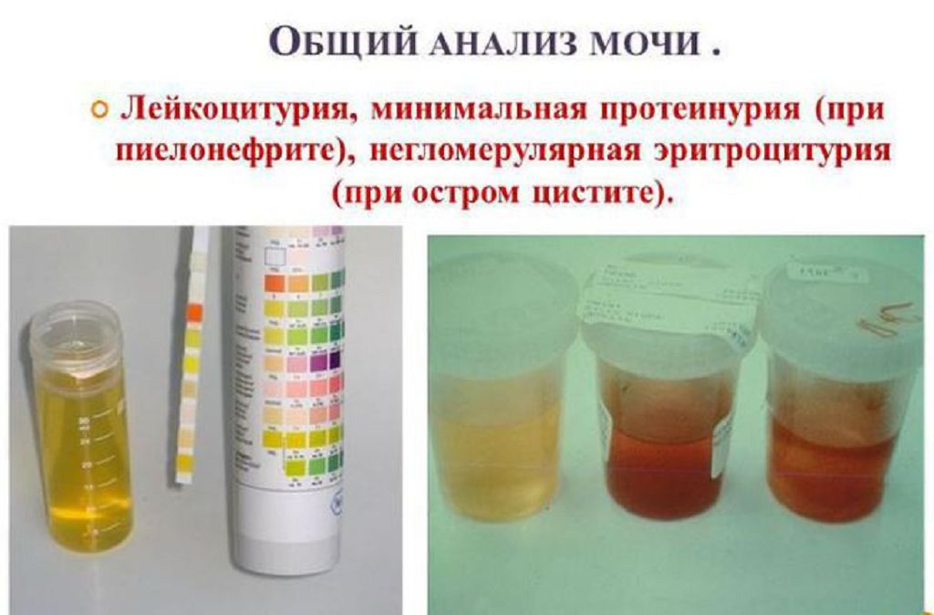 Лейкоциты и эритроциты в моче: причины повышения у мужчин и женщин