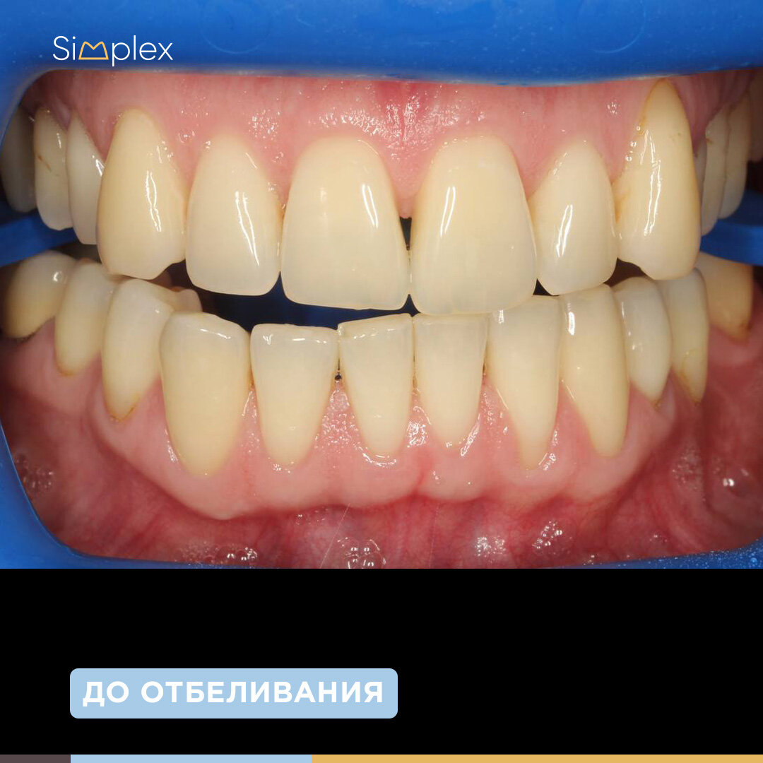 Фото зубов до отбеливания
