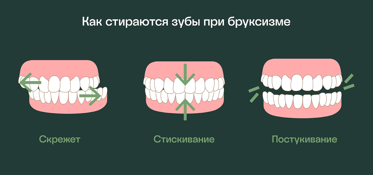 Как стираются зубы при бруксизме.