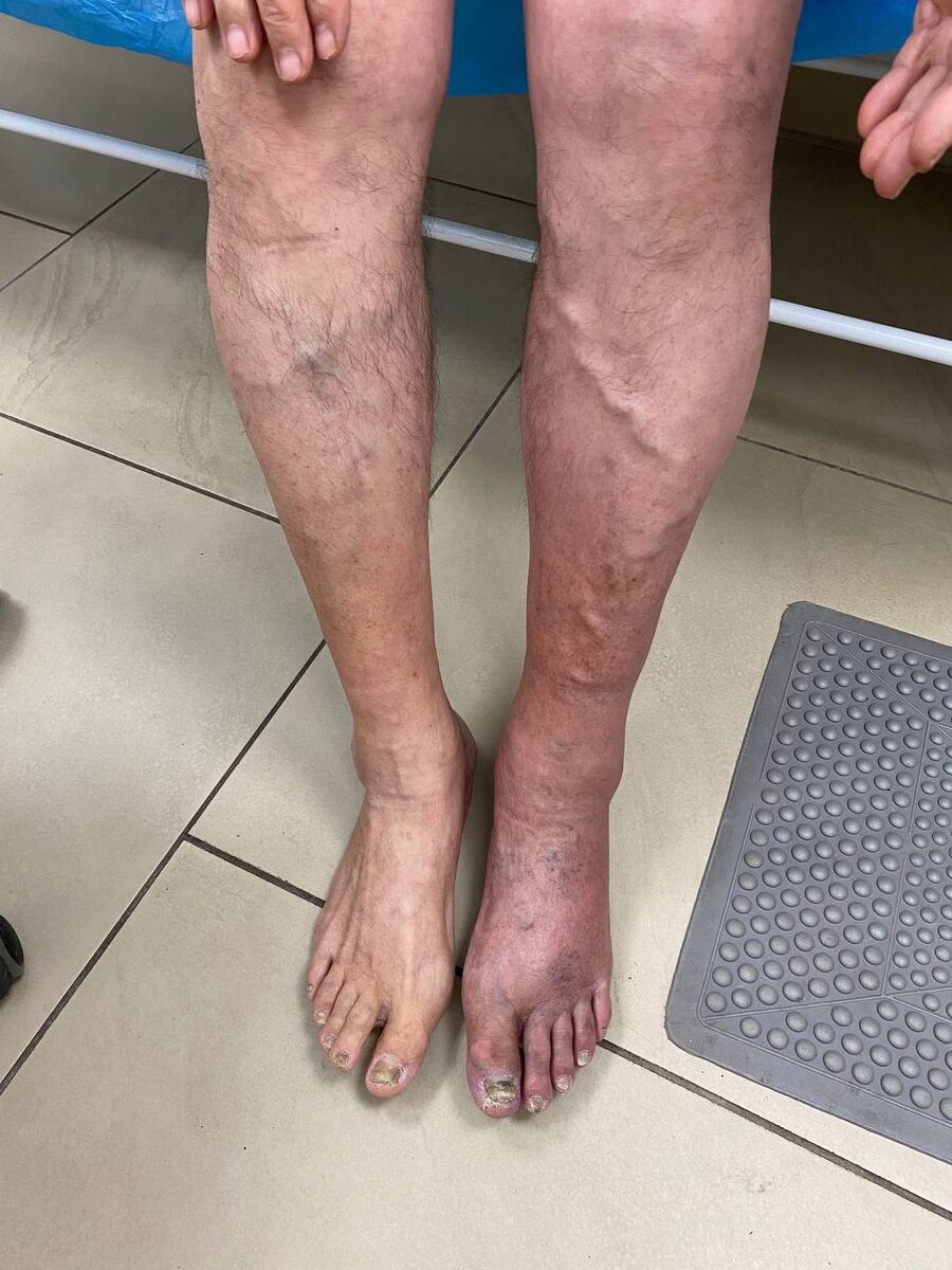 Отекшая синюшная напряженная и резко болезненная нижняя конечность вследствие закупорки бедренных вен. Мужчина 53 лет. Фото с приема (Саратов)