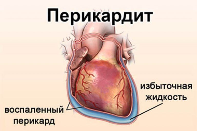 Воспалительные заболевания сердца перикардит. Патология перикарда у животных. Экссудативный перикардит у животных. Воспаление сердечной сумки.