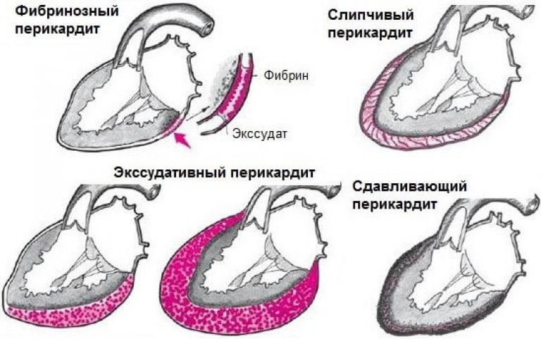 Перикардит презентация. Перикардит презентация. Туберкулезный выпотной перикардит. Хронический выпотной перикардит. Хронический слипчивый перикардит.
