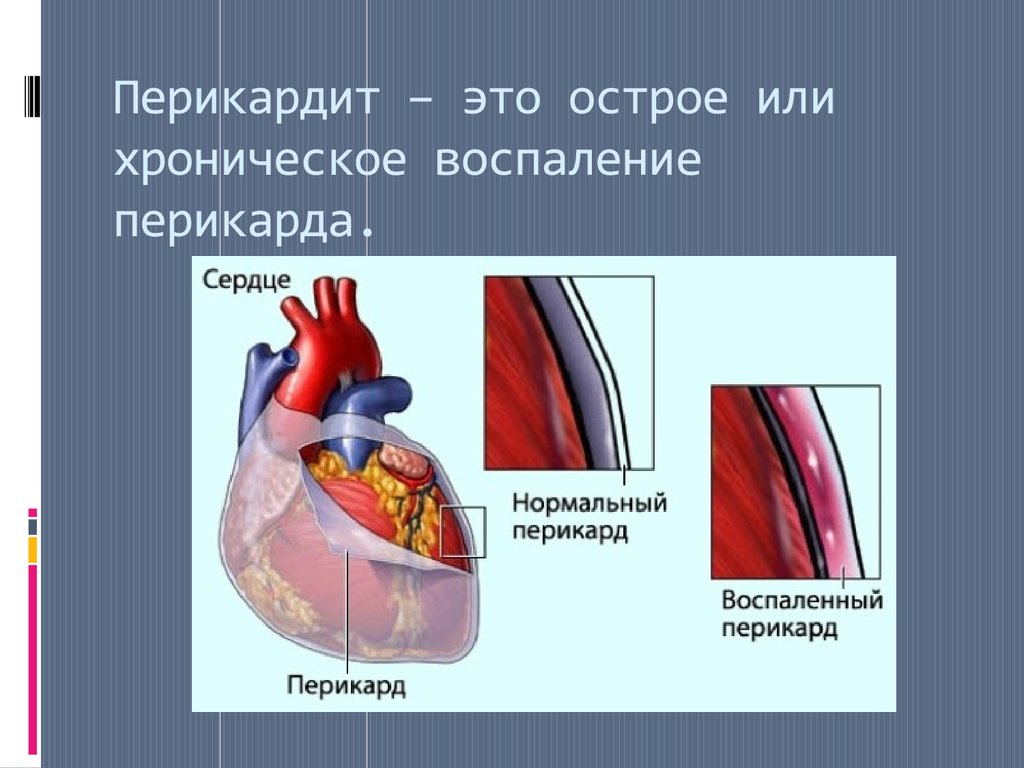 Жидкость в полости перикарда сердца. Экссудат в полости перикарда.