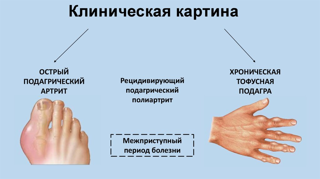 Подагра при сахарном диабете. Подагра клинические рекомендации тофусы. Клинические проявления подагры. Клинические симптомы подагры. Хроническая тофусная подагра и острый подагрический артрит.