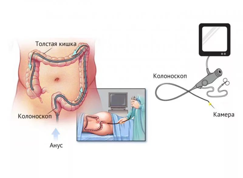 Узи колоноскопия кишечника