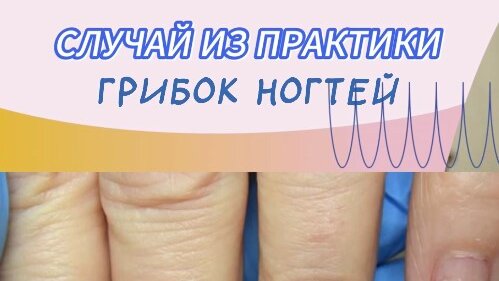 КЛИНИКА ПОДОЛОГИИ ПОЛЁТ | СЛУЧАЙ ИЗ ПРАКТИКИ: грибок ногтей / лечение ...