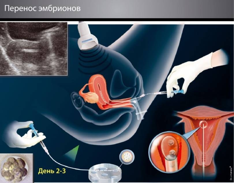 Почему подсаживают. Перенос эмбриона в матку. Матка после подсадки эмбрионов. Эмбрион в матке после переноса. Эко это искусственное оплодотворение.