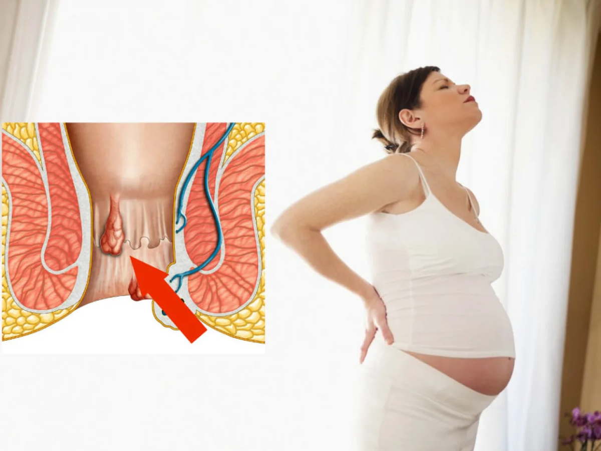 Боль в заднем проходе при беременности. Геморрой беременность. Гемморойпри беременности.