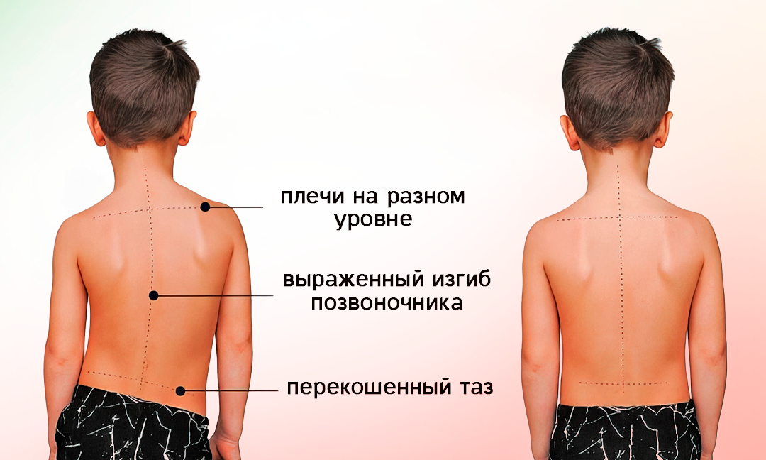 Как проходит лечение сколиоза при помощи остеопатии?