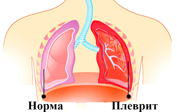 Картина плевра. Сухой фибринозный плеврит осложнения. Сухой и экссудативный плеврит.