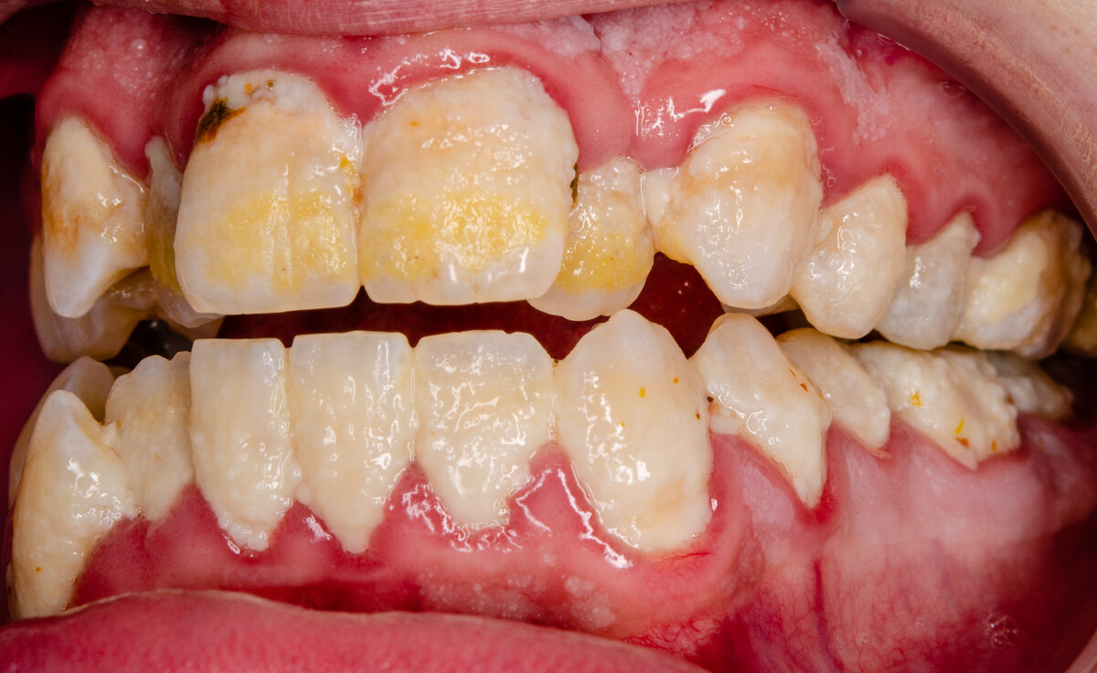 Чистка зубов после каждого приема пищи: почему это самая бесполезная ...