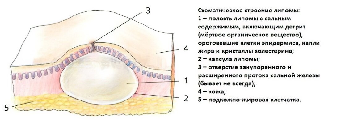 Остеохондромы, липомы, гемангиомы, мезенхиомы кисти