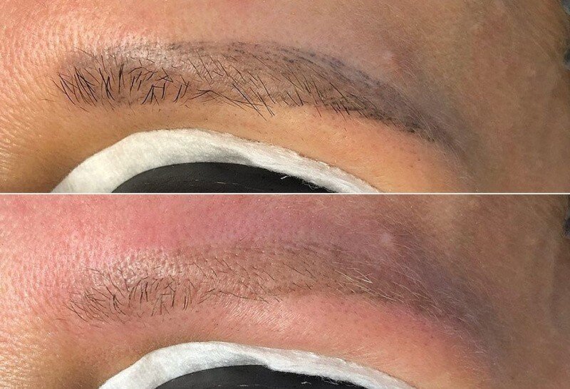 Ошибки при удалении перманента бровей лазером — Teletype