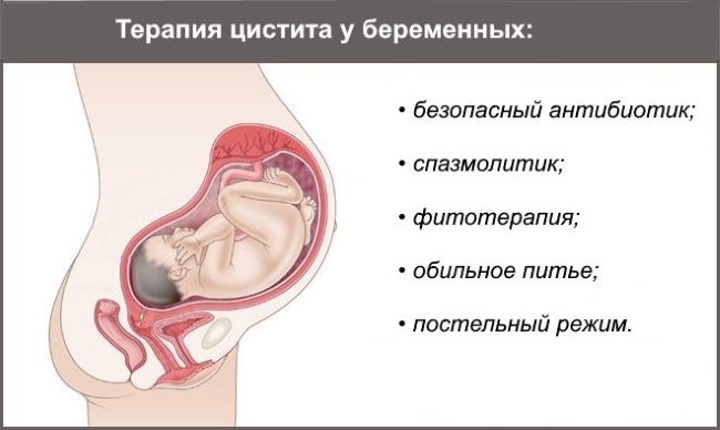 Как лечат цистит во время беременности
