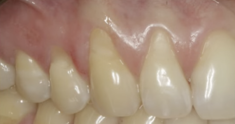 Примеры рецессии десны 