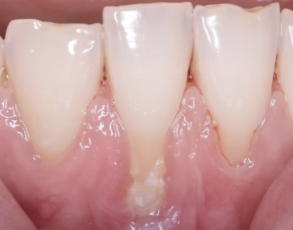 Оголение корней зубов – не только эстетический дефект