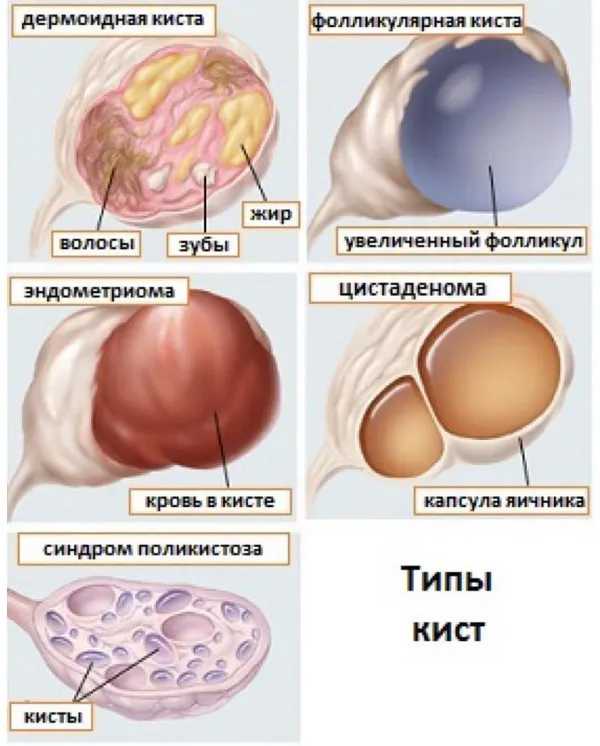 Эндометриоидная киста левого яичника. Фолликулярная киста яичника классификация. Фолликулярная (функциональная) киста. KVCNF. Признаки кистозных изменений