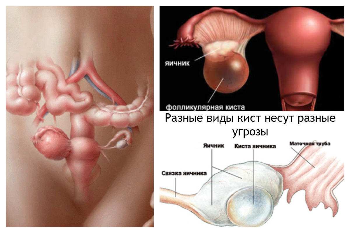 Боль при овуляции: почему возникает, причины, что делать и как лечить