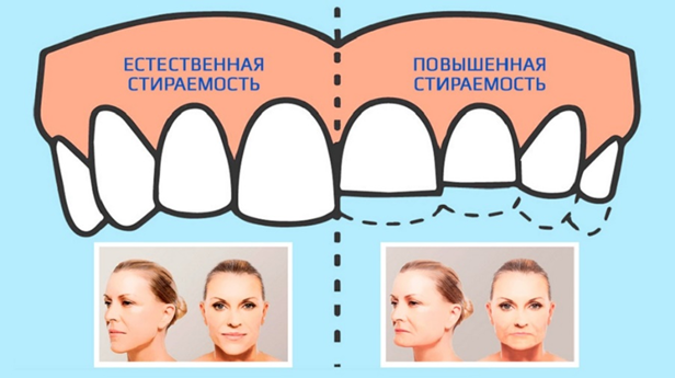 Патологическая стираемость зубов: что это и как её распознать